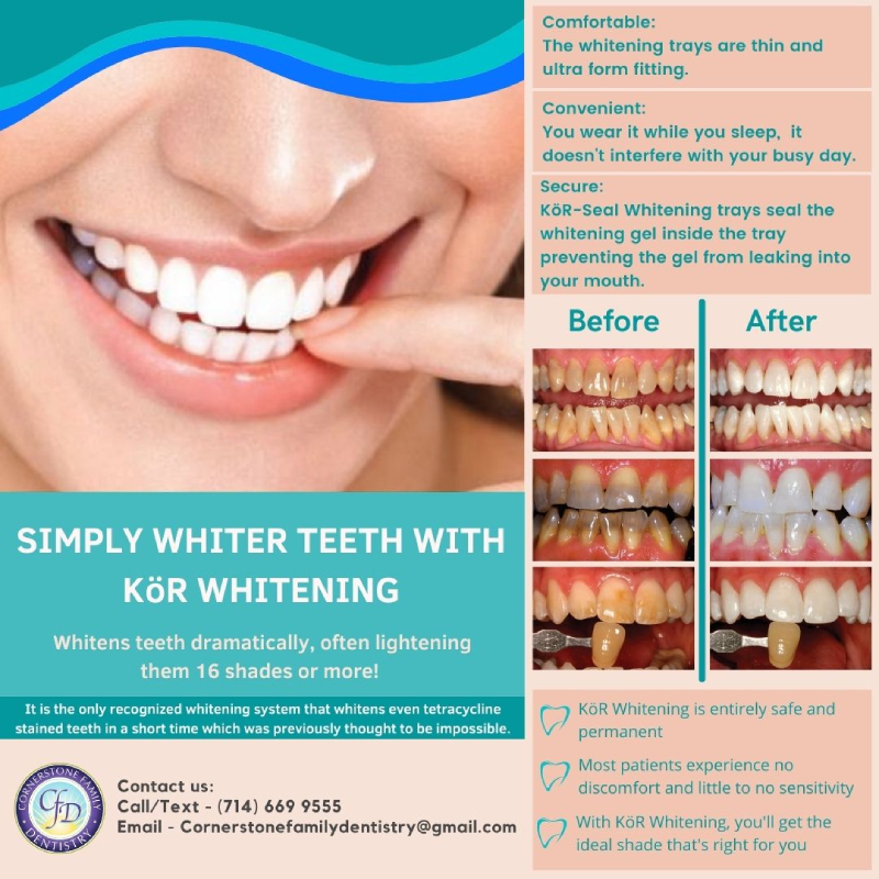 Teeth Whitening in Tustin