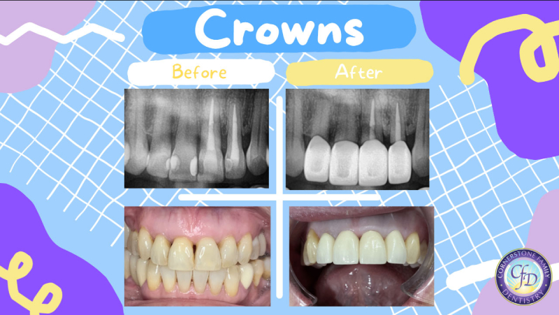 Dental Crowns in Tustin