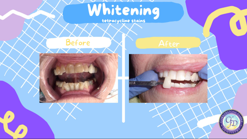 Teeth Whitening in Tustin