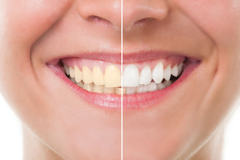 Teeth Whitening in Tustin